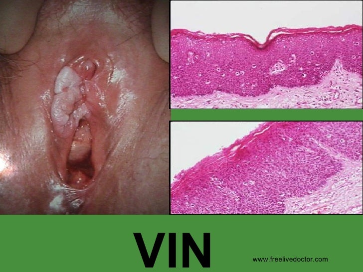 pictures vaginal disorders Pictures vaginal disorders